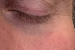 xlash eye patches test